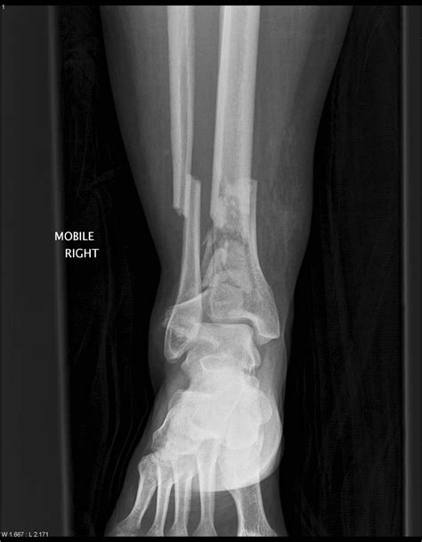 Pilon Fracture at Faith Fussell blog