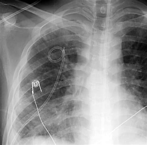 Pigtail Catheter Chest Tube Placement at Lynn Morgan blog