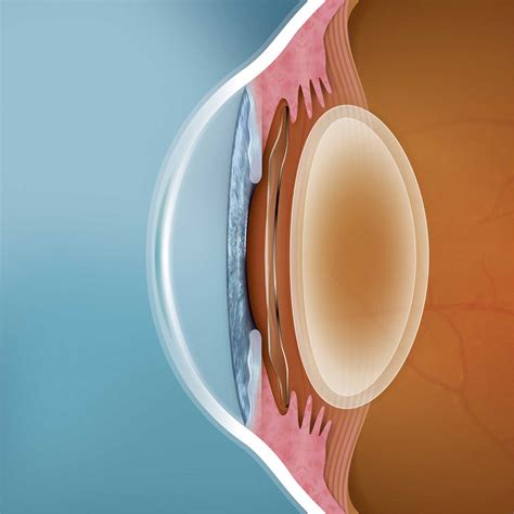 Implantable Contact (Collamer) Lens - Dr Lynn Yeo | Experienced Eye Surgeon, Singapore