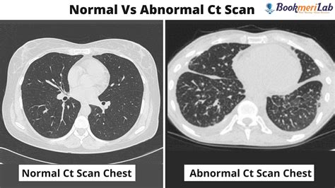 CT Scan Chest: Purpose, Results, COVID-19 & Cost [2022]