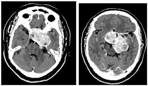 Staged Strategies to Deal with Complex, Giant, Multi-Fossa Skull Base Tumors