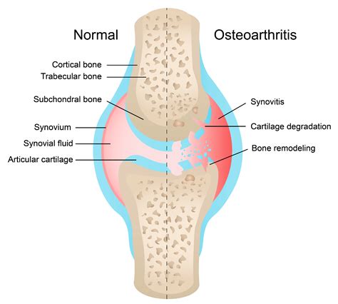 Diagrammatic Overview Of Osteoarthritis Pathology Sagittal View Of The