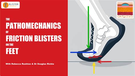 Pathomechanics of Friction Blisters on the Feet - Blister Prevention Pro