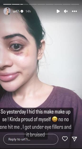 Urfi Javed's undereye fillers go miserably wrong; actress shares photo ...