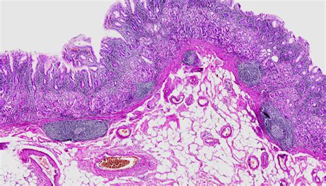 Possible Risks and Side Effects of Probiotics in Gastritis – thegoodbug