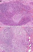 Image result for inflammatory mass