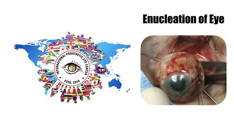 Enucleation Of Eye