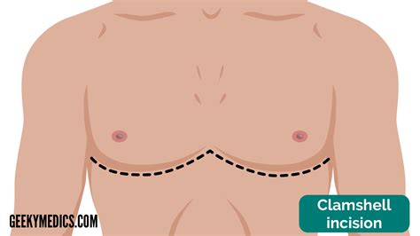 Image result for Clamshell Thoracotomy