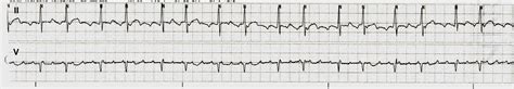 Image result for Atrial Flutter ECG Pattern