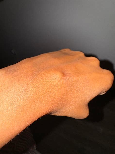 bump on hand : r/Orthopedics