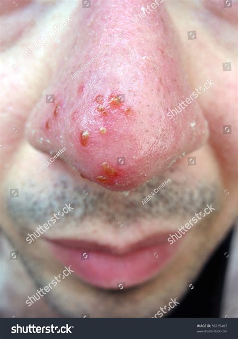 A Medical Condition Closeup Of The Common Cold Sore Virus Herpes Simplex On An Infected Victims ...