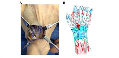 Image result for Extensor Digitorum Communis Surgery