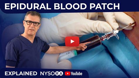 Epidural Blood Patch: How To - NYSORA