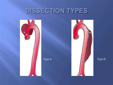 Contemporary management of acute type b aortic dissections | PPTX