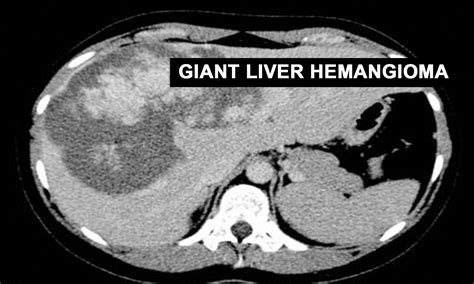 Early surgical resection- a benefit for Giant Liver Hemangiomas: Case ...