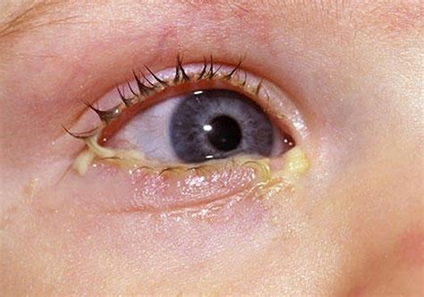 👉 Mucus in Eye - Types, Pictures, Home Remedies, Yellow Mucus (November ...