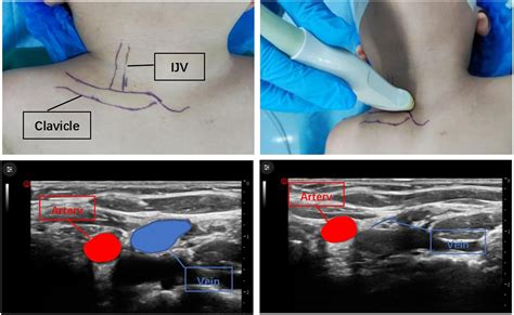 An Innovative Method to Prevent Guidewire Access to the Ipsilateral ...