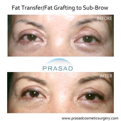 Fat Grafts - Fat Transfer to Eyes, Face and Hand | New York