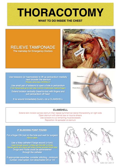 Image result for Thoracotomy Recovery