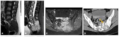 Beyond Chordoma: A Comprehensive Review of Sacral Lesions