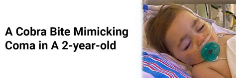 A Cobra Bite Mimicking Coma in a 2-year-old