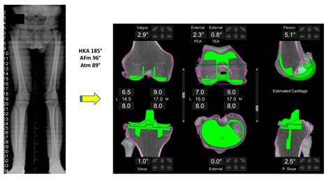 Functional Alignment Philosophy in Total Knee Arthroplasty—Rationale ...