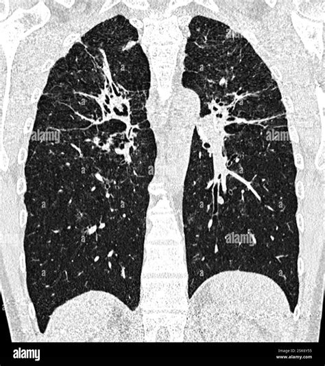 Pulmonary fibrosis in sarcoidosis. Coronal computed tomography (CT) scan of the chest of a 42 ...