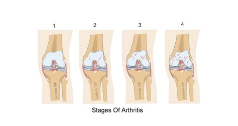 Stages of Arthritis | Arthritis VIP | Dr. Mark Hawass