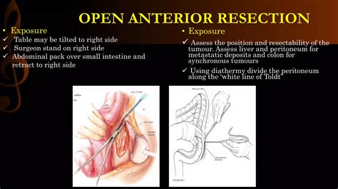 Image result for Apr Resection Surgery