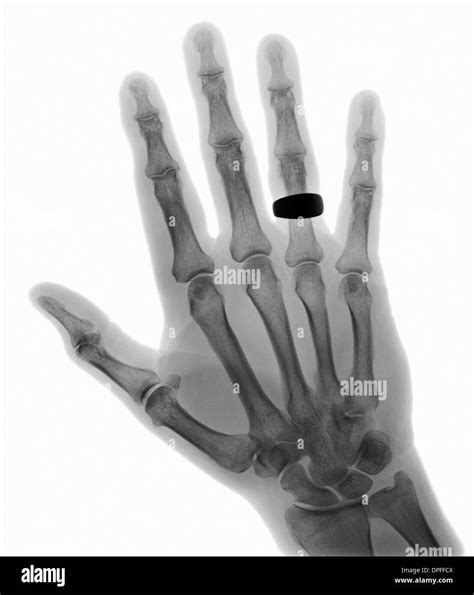 X ray normal hand hi-res stock photography and images - Alamy