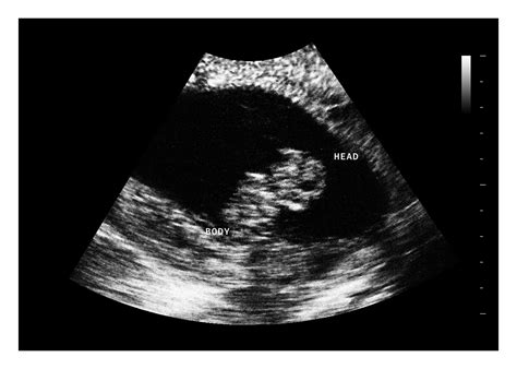 8 Week Ultrasound: What to Expect