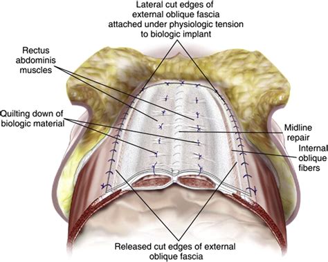 Open Ventral Hernia Repair with Component Separation - Surgical Clinics
