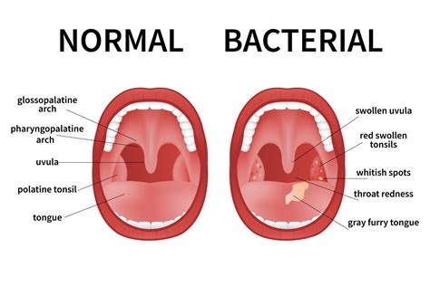 Tonsils Viral Vs Bacterial