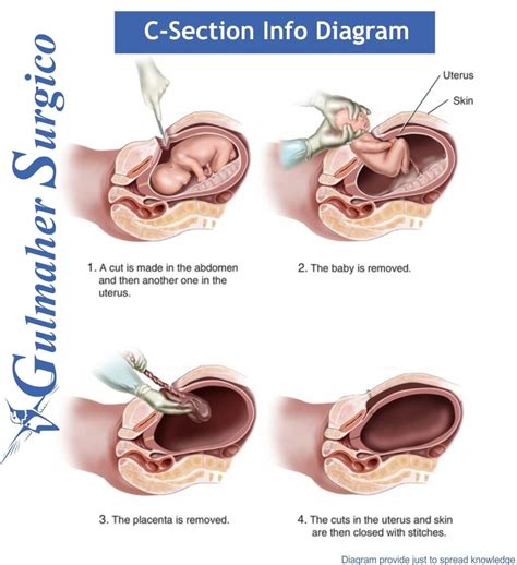 Cesarean Section Diagram
