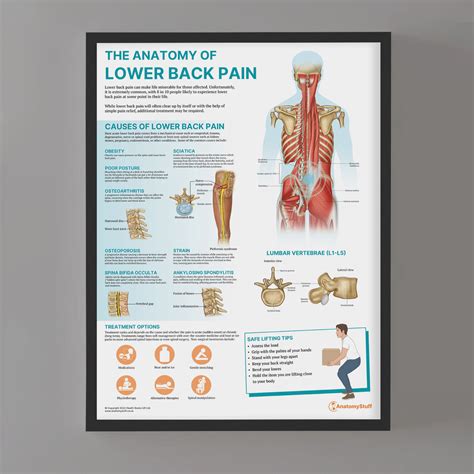 The Anatomy of Lower Back Pain Poster | Patient Education Tool – AnatomyStuff - back pain chart