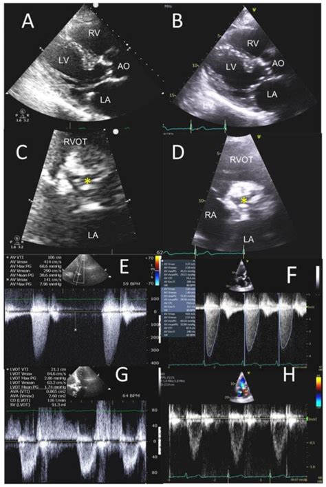Point-of-Care Ultrasound in Detection, Severity and Mechanism of ...