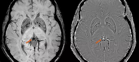 Philips Achieva dStream 3.0T – Circular edition