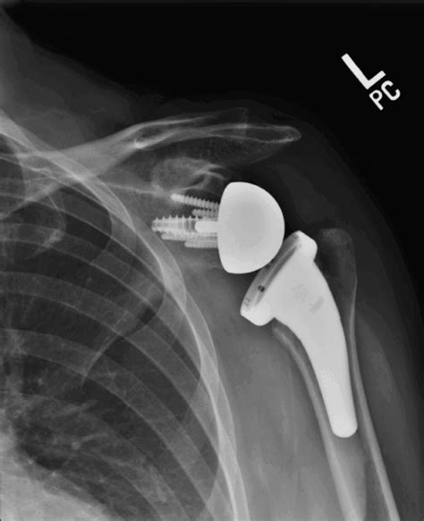 Reverse Shoulder Replacement FAQ's: Dr McClintock Roseville CA