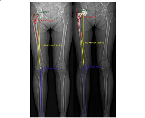 Image result for Leg Alignment