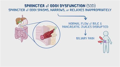 Sphincter of Oddi dysfunction: Year of the Zebra 2024: Video, Causes, & Meaning | Osmosis