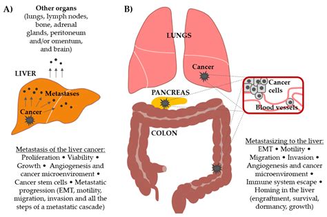 Wnt Signaling Pathway Is among the Drivers of Liver Metastasis