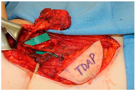 Evolution of Medical Modeling and 3D Printing in Microvascular Midface ...