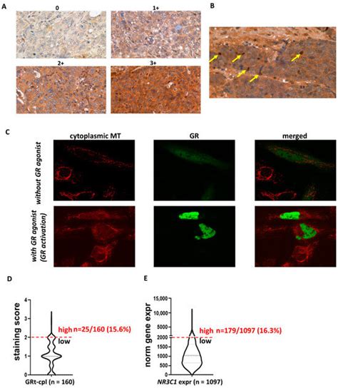 Glucocorticoid Receptor Isoforms in Breast Cancer Raise Implications ...