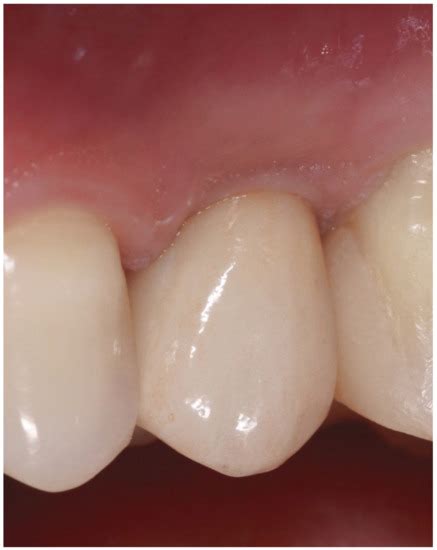 Digital versus Traditional Workflow for Immediate Loading in Single ...
