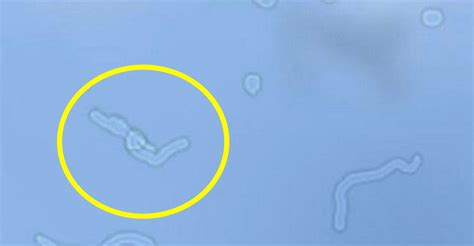 Diabetic Retinopathy: How to Avoid and How to Cure | by Shifa Siddiqui ...