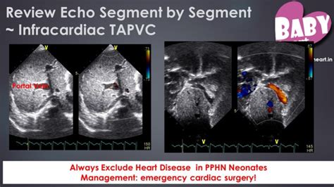 Pulmonary Hypertension in Children – Recent updates & Indian scenario ...