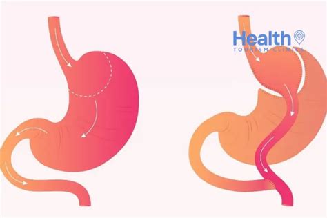 Gastric Bypass Turkey - 2023 Price & Review Clinics