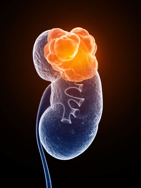 Cancer Kidneys Symptoms - 5 Signs and Symptoms of Kidney Cancer : Learn about symptoms ...