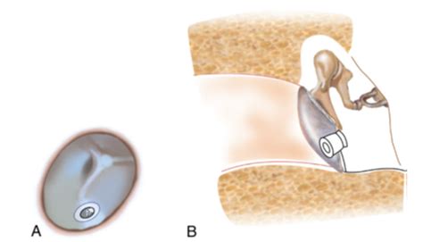 Ear Infection in Paediatric Patients