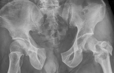 Etiologi Fraktur Pelvis - Alomedika